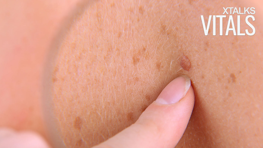 Skin Cancer