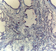 fibrosis