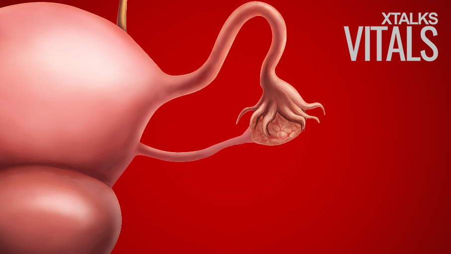 Ovarian Cancer