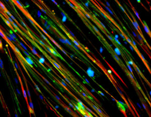 Image of muscle cells after gene therapy for Duchenne Muscular Dystrophy