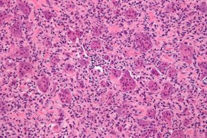 H&E stain of a bone tumor micrograph