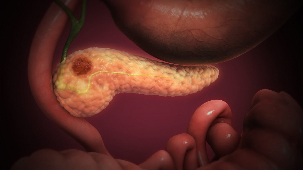 Tumor in pancreas