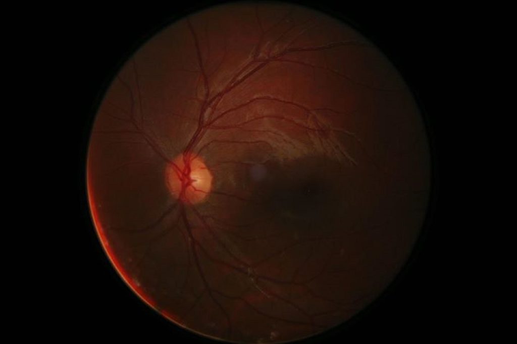 Digital retinal image