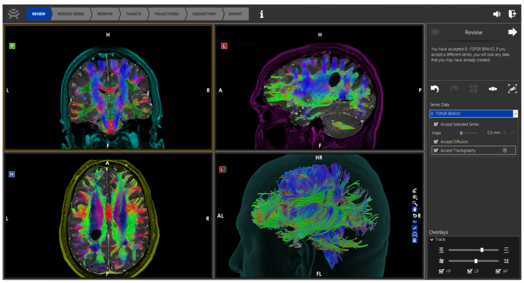 Modus Plan software. Image courtesy of Synaptive Medical.