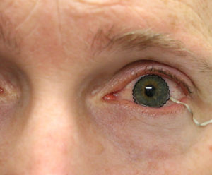 Contact lens