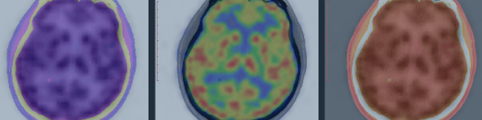 Neuro PET Webinar xTalks Hero Image
