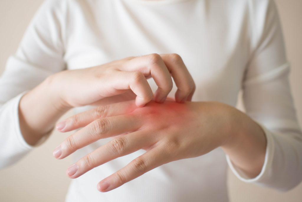 Eczema Treatment