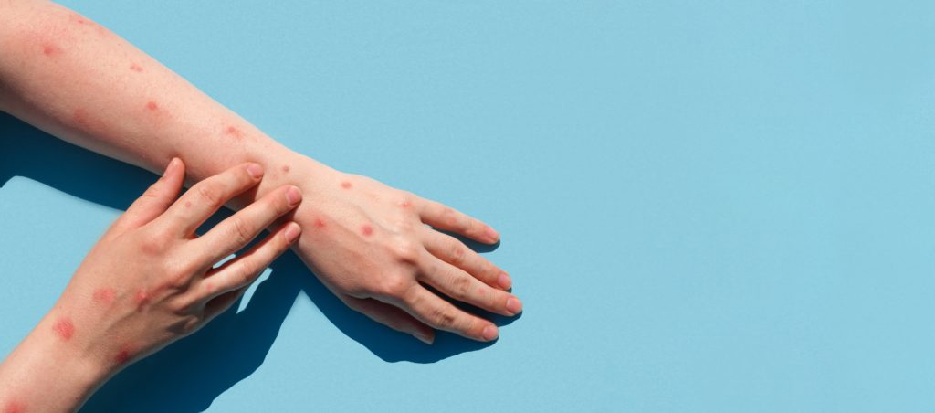 Monkeypox test