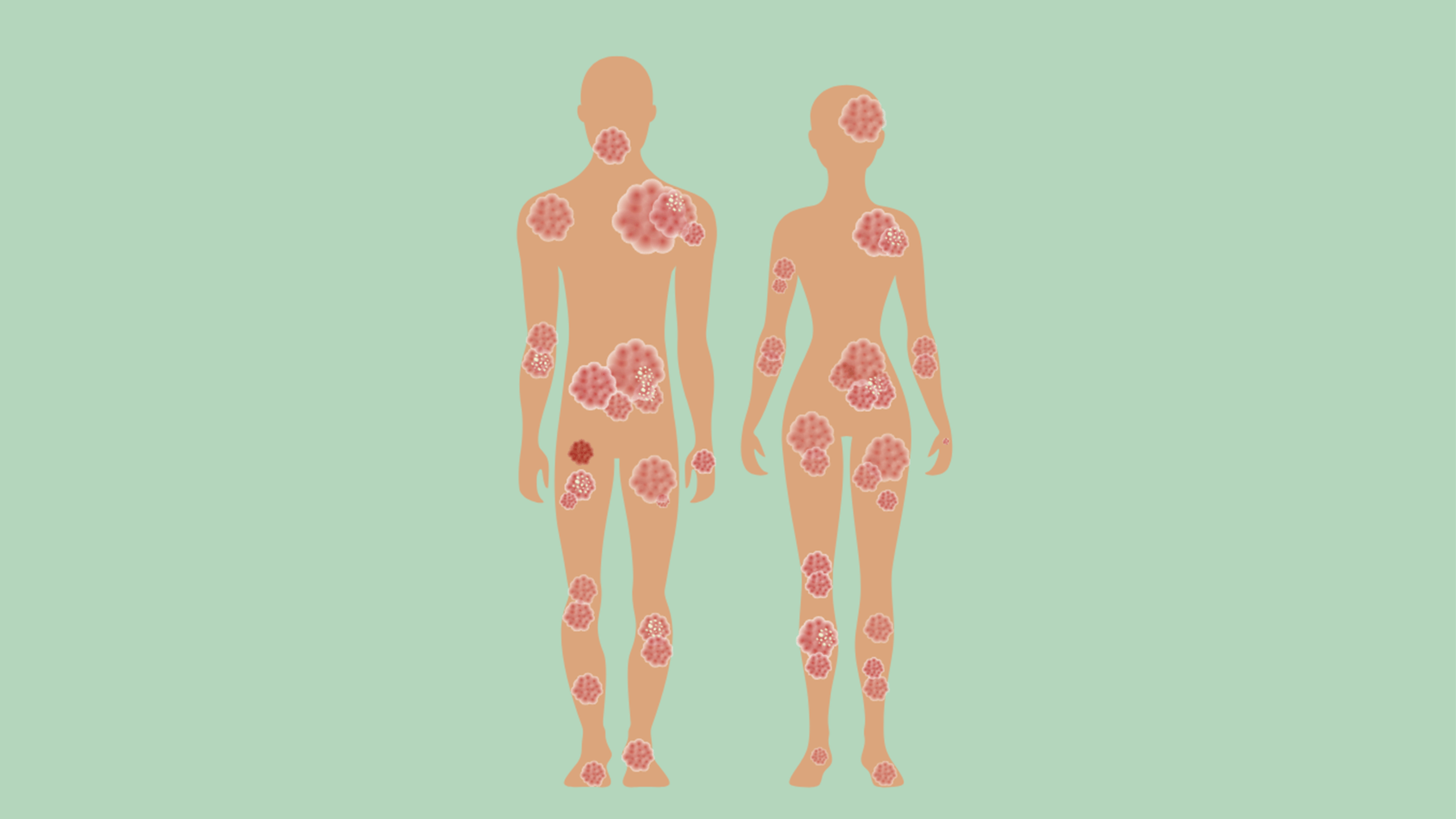 Boehringer Ingelheim’s Spevigo (spesolimab-sbzo) was FDA-approved as the first treatment option for generalized pustular psoriasis (GPP) flares in adults.
