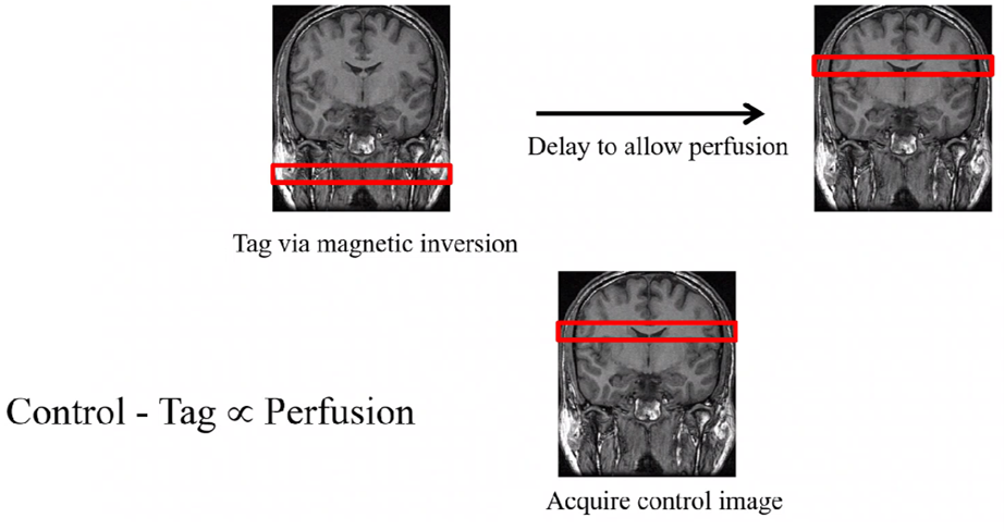 Perfusion MRI & Perfusion Imaging