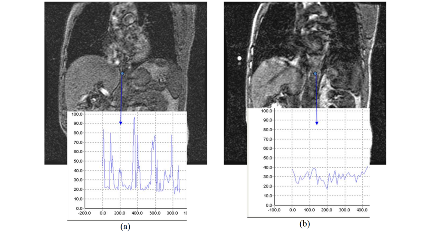 Perfusion MRI & Perfusion Imaging