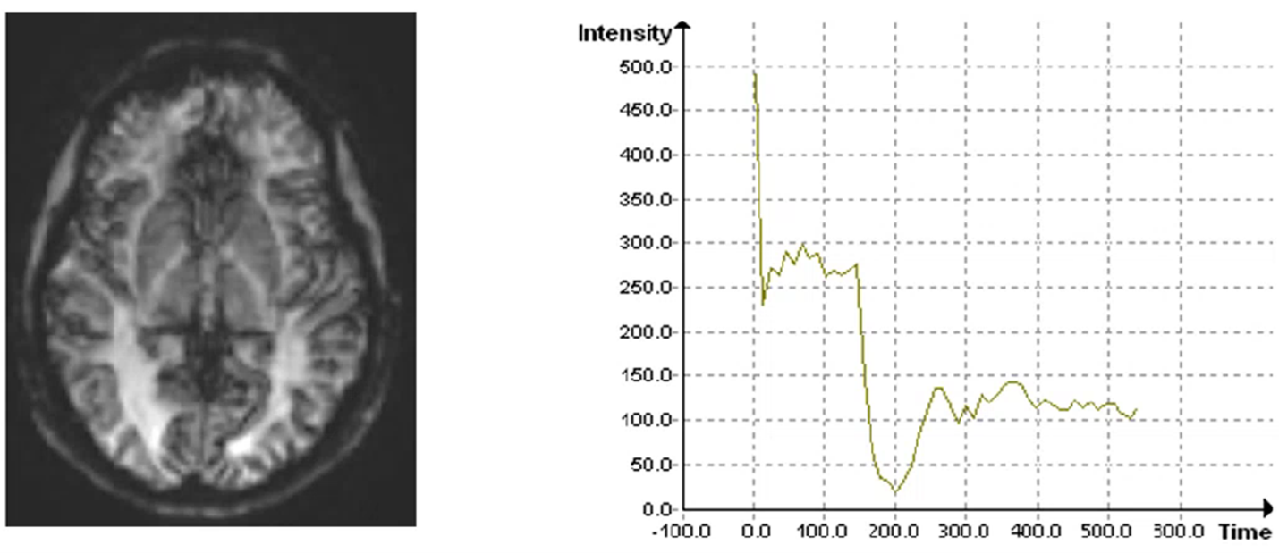 Perfusion MRI & Perfusion Imaging