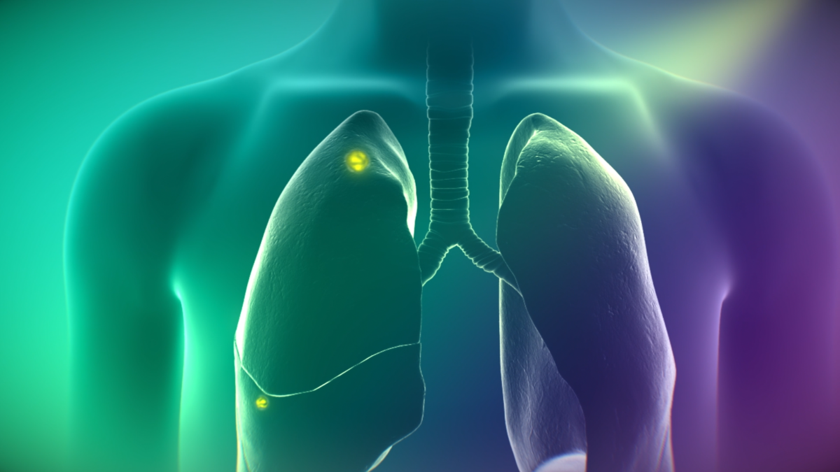 Imaging Drug Cytalux (pafolacianine) Approved in Lung Cancer