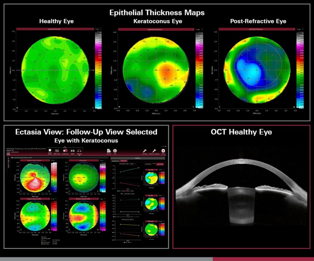 Eye Imaging