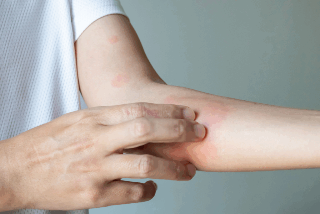 Starjemza, Ustekinumab, Psoriasis, Psoriatic Arthritis, stelara biosimilar, biosimilar for stelara