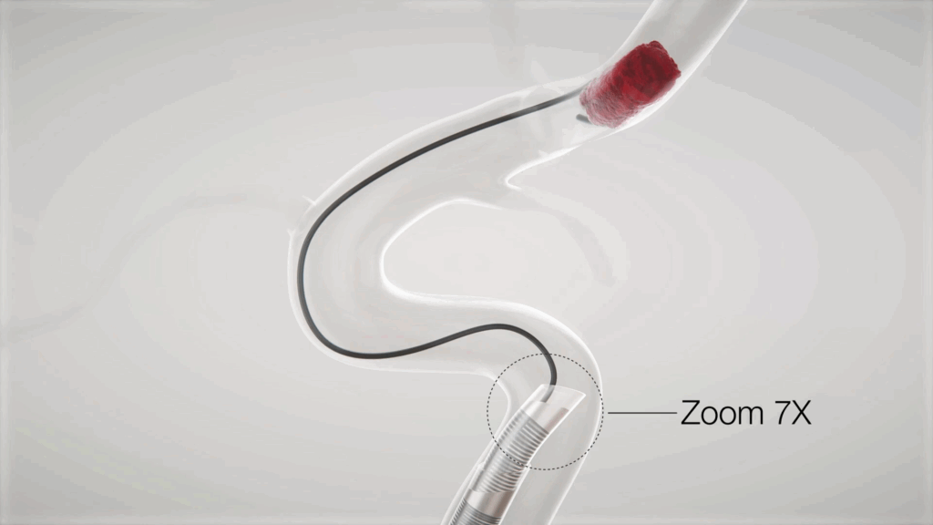 Aspiration Catheter, thrombectomy, stroke intervention, what is an ischemic stroke, acute ischemic stroke, ischemic stroke treatment, what is a thrombectomy, mechanical thrombectomy, thrombectomy procedure, imperative care, aspiration catheter, aspiration catheter thrombectomy