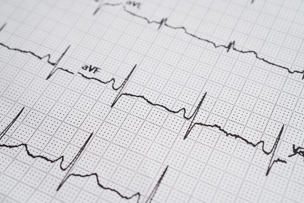 AI ECG