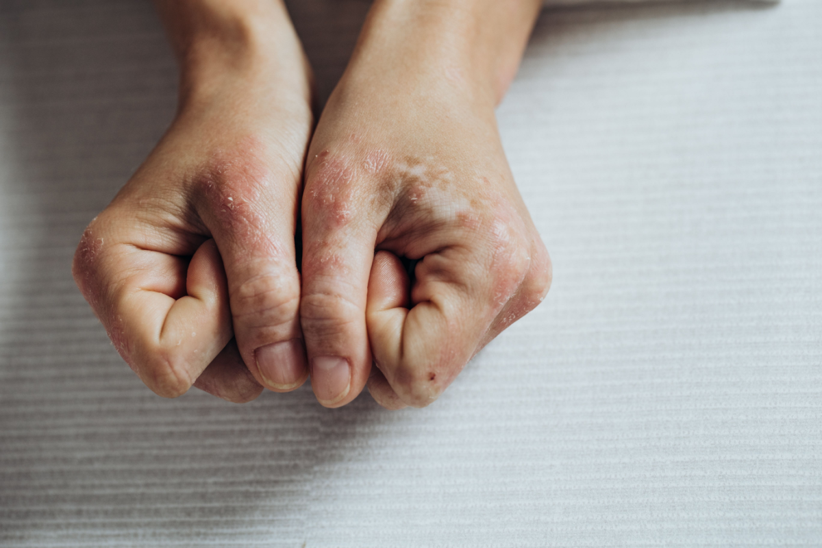 Psoriasis Awareness Month 2025, psoriasis awareness month, national psoriasis awareness month, psoriasis, psoriatic arthritis